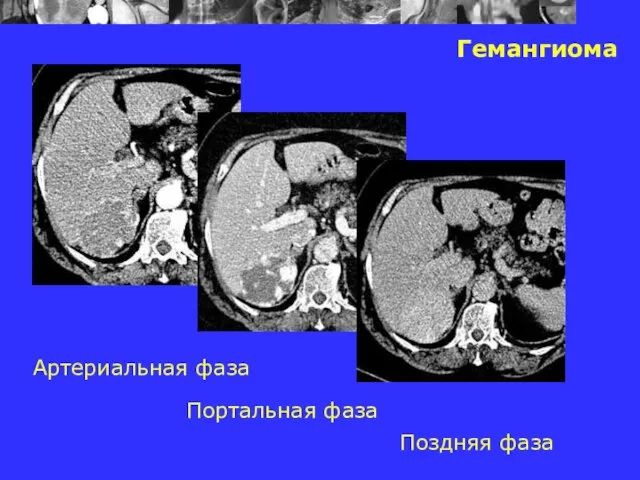 Гемангиома Артериальная фаза Портальная фаза Поздняя фаза