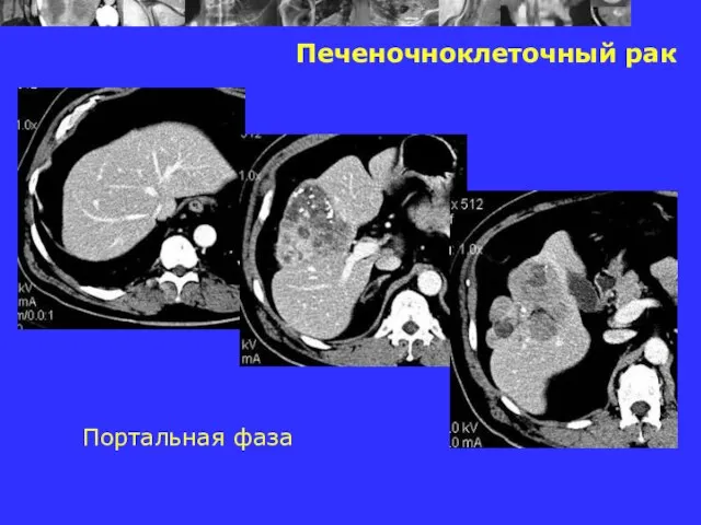 Печеночноклеточный рак Портальная фаза