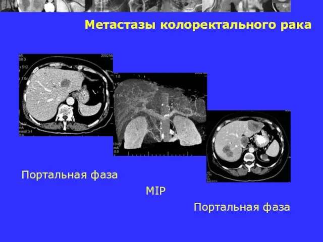 Метастазы колоректального рака Портальная фаза MIP Портальная фаза