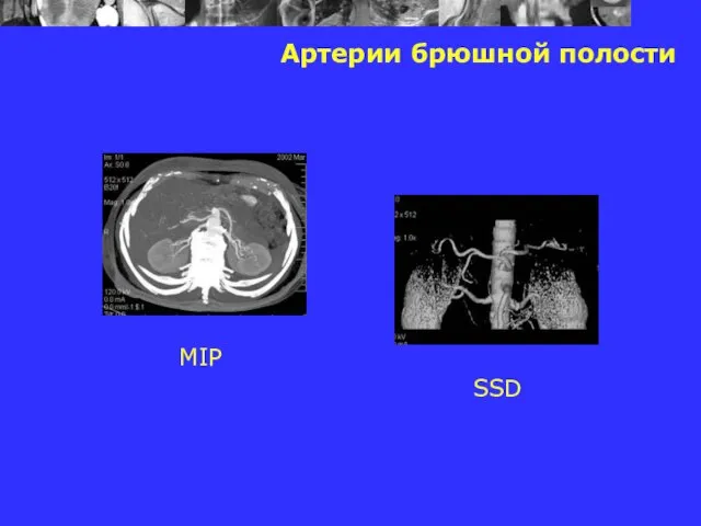 Артерии брюшной полости MIP SSD