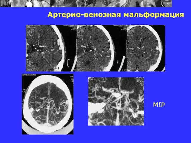 Артерио-венозная мальформация MIP