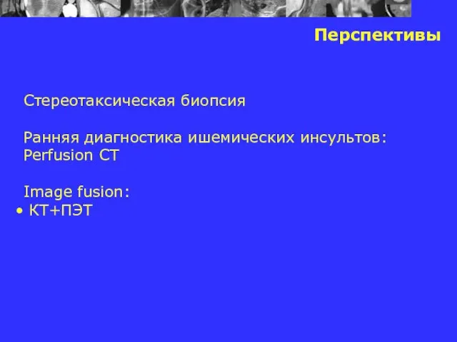 Перспективы Стереотаксическая биопсия Ранняя диагностика ишемических инсультов: Perfusion CT Image fusion: КТ+ПЭТ