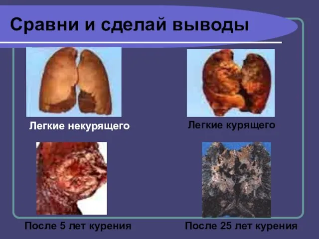 Сравни и сделай выводы После 5 лет курения После 25 лет курения Легкие некурящего Легкие курящего