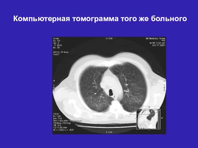 Компьютерная томограмма того же больного