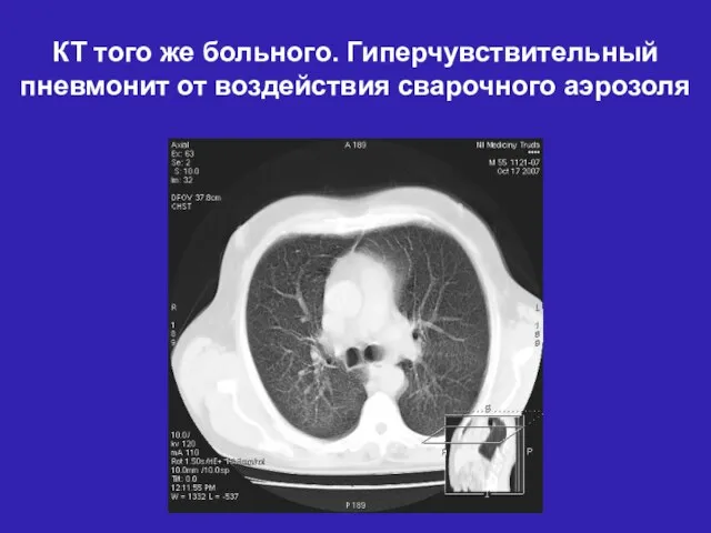 КТ того же больного. Гиперчувствительный пневмонит от воздействия сварочного аэрозоля