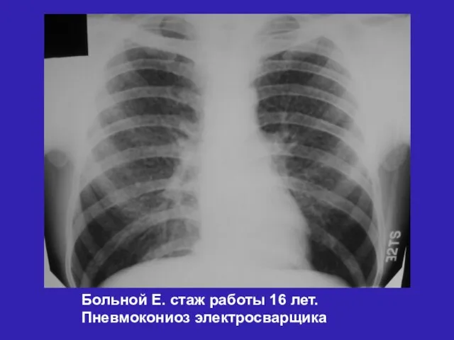 Больной Е. стаж работы 16 лет. Пневмокониоз электросварщика