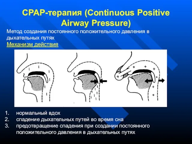 СРАР-терапия (Continuous Positive Airway Pressure) Метод создания постоянного положительного давления в дыхательных