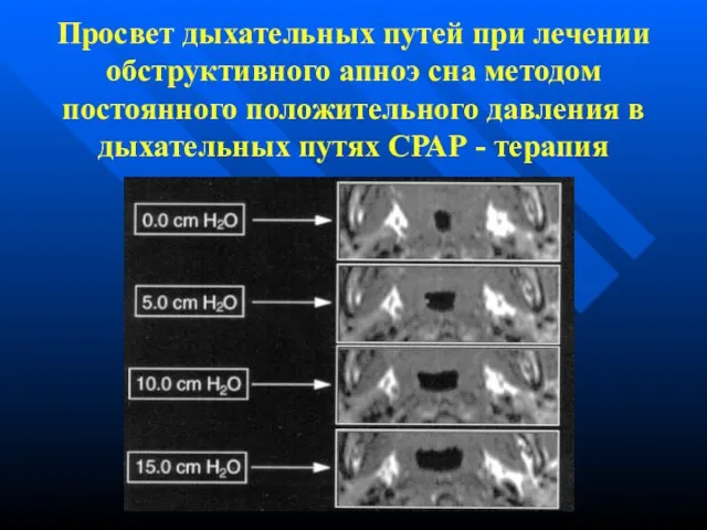 Просвет дыхательных путей при лечении обструктивного апноэ сна методом постоянного положительного давления