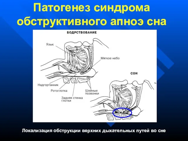 Патогенез синдрома обструктивного апноэ сна Локализация обструкции верхних дыхательных путей во сне