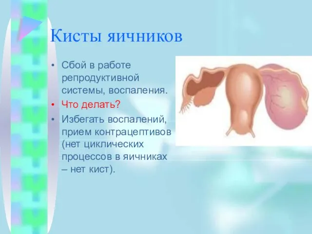 Кисты яичников Сбой в работе репродуктивной системы, воспаления. Что делать? Избегать воспалений,