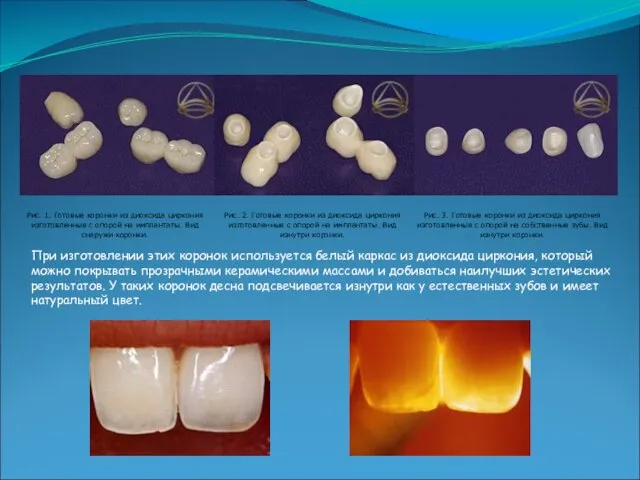 При изготовлении этих коронок используется белый каркас из диоксида циркония, который можно