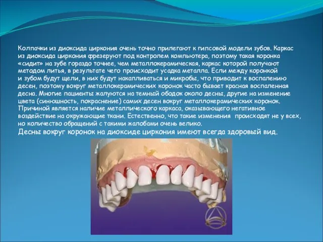 Колпачки из диоксида циркония очень точно прилегают к гипсовой модели зубов. Каркас