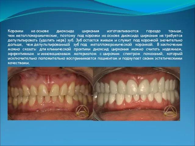 Коронки на основе диоксида циркония изготавливаются гораздо тоньше, чем металлокерамические, поэтому под