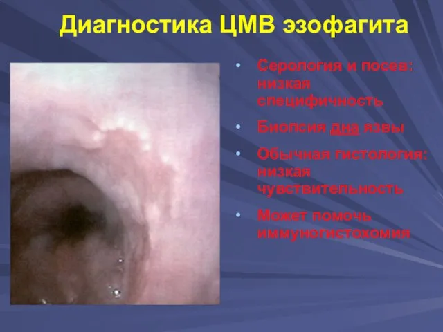 Диагностика ЦМВ эзофагита Серология и посев: низкая специфичность Биопсия дна язвы Обычная