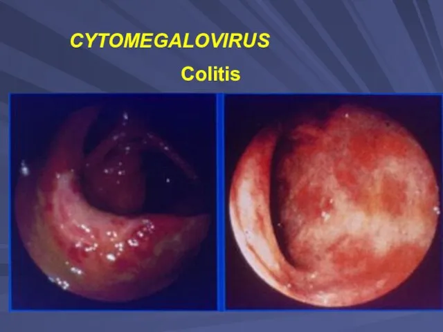 CYTOMEGALOVIRUS Colitis