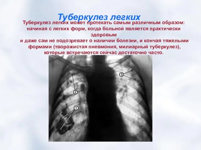 Туберкулез легких Туберкулез легких может протекать самым различным образом: начиная с легких
