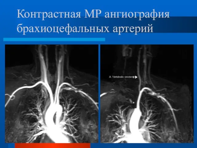 Контрастная МР ангиография брахиоцефальных артерий
