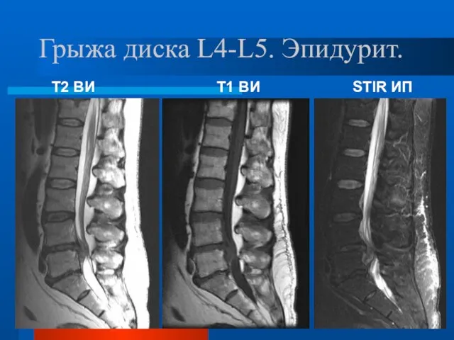 Грыжа диска L4-L5. Эпидурит. Т2 ВИ Т1 ВИ STIR ИП