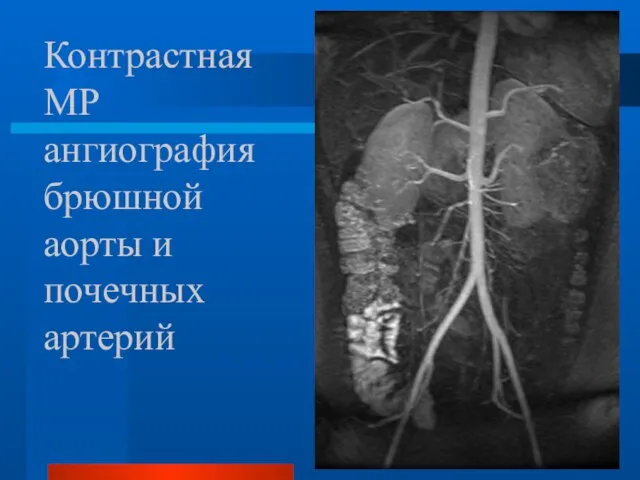 Контрастная МР ангиография брюшной аорты и почечных артерий