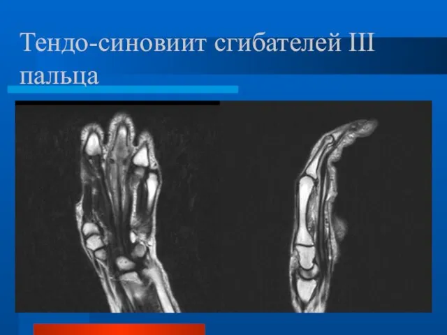Тендо-синовиит сгибателей III пальца