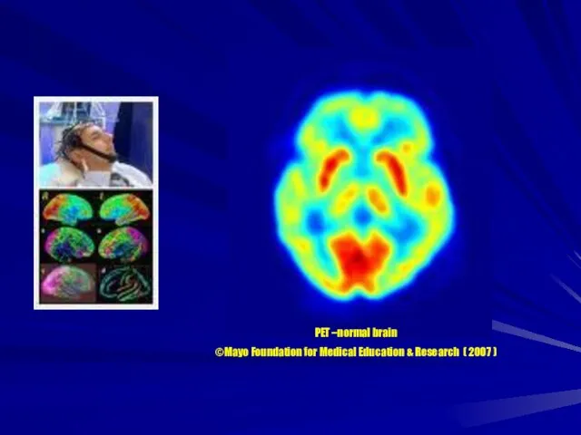 PET –normal brain ©Mayo Foundation for Medical Education & Research ( 2007 )
