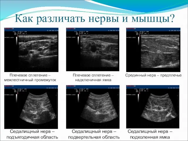 Как различать нервы и мышцы? Плечевое сплетение – межлестничный промежуток Плечевое сплетение