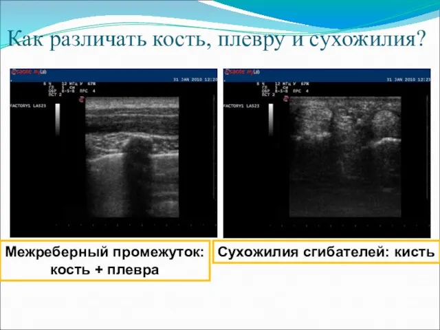 Как различать кость, плевру и сухожилия? Межреберный промежуток: кость + плевра Сухожилия сгибателей: кисть