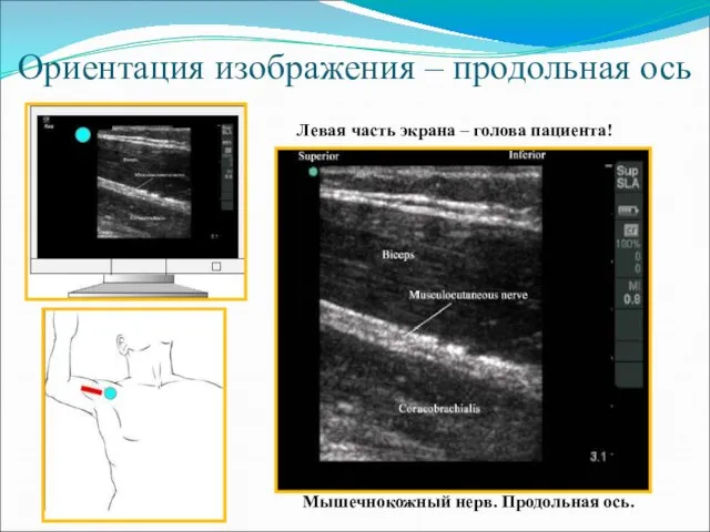 Ориентация изображения – продольная ось Мышечнокожный нерв. Продольная ось. Левая часть экрана – голова пациента!