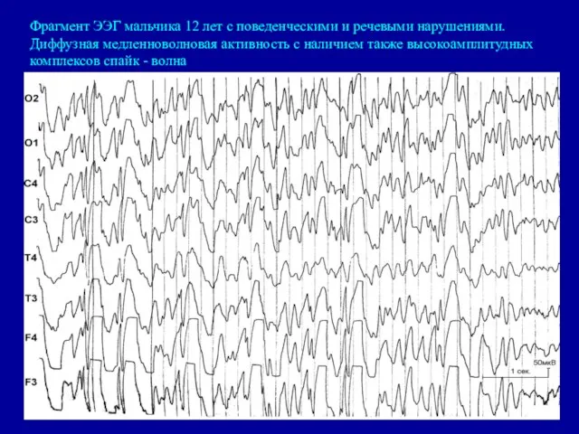 Фрагмент ЭЭГ мальчика 12 лет с поведенческими и речевыми нарушениями. Диффузная медленноволновая