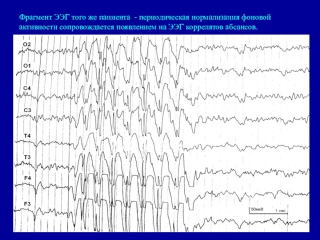Фрагмент ЭЭГ того же пациента - периодическая нормализация фоновой активности сопровождается появлением на ЭЭГ коррелятов абсансов.