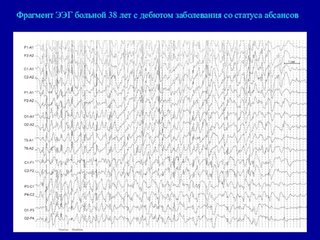 Фрагмент ЭЭГ больной 38 лет с дебютом заболевания со статуса абсансов