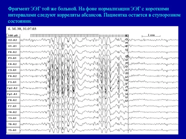 Фрагмент ЭЭГ той же больной. На фоне нормализации ЭЭГ с короткими интервалами