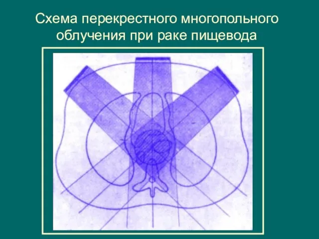 Схема перекрестного многопольного облучения при раке пищевода