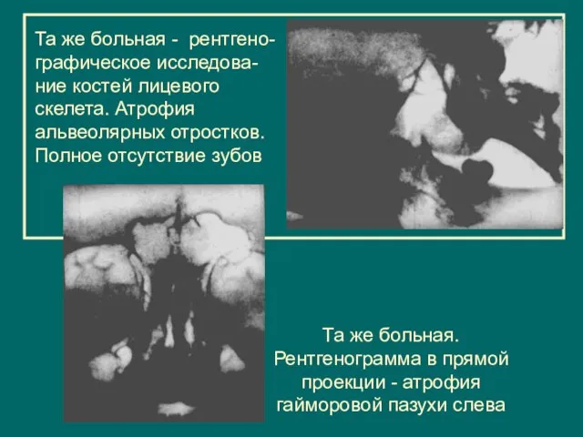 Та же больная - рентгено- графическое исследова-ние костей лицевого скелета. Атрофия альвеолярных