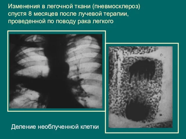 Изменения в легочной ткани (пневмосклероз) спустя 8 месяцев после лучевой терапии, проведенной