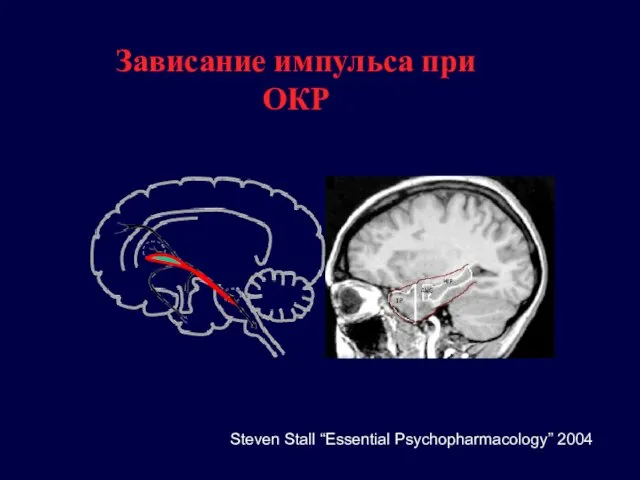 Зависание импульса при ОКР Steven Stall “Essential Psychopharmacology” 2004