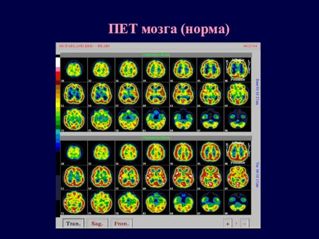 ПЕТ мозга (норма)