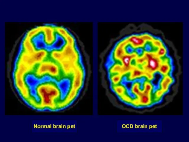 Normal brain pet OCD brain pet