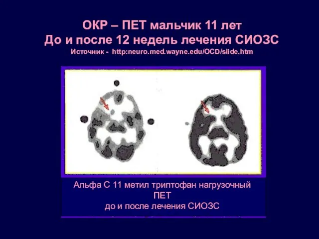 ОКР – ПЕТ мальчик 11 лет До и после 12 недель лечения