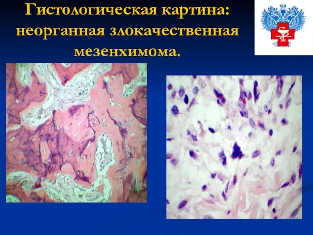 Гистологическая картина: неорганная злокачественная мезенхимома.