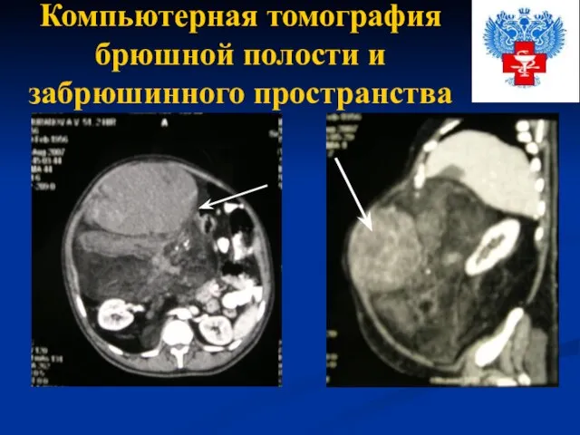 Компьютерная томография брюшной полости и забрюшинного пространства