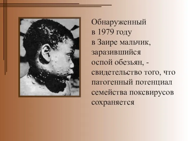 Обнаруженный в 1979 году в Заире мальчик, заразившийся оспой обезьян, - свидетельство