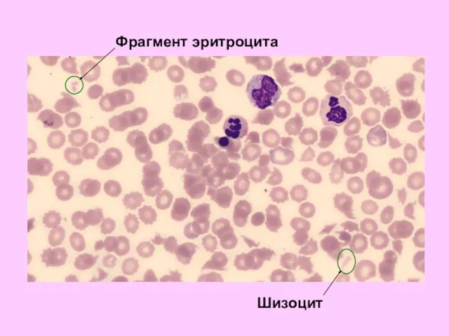 Фрагмент эритроцита Шизоцит