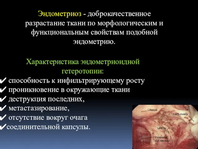 Эндометриоз - доброкачественное разрастание ткани по морфологическим и функциональным свойствам подобной эндометрию.