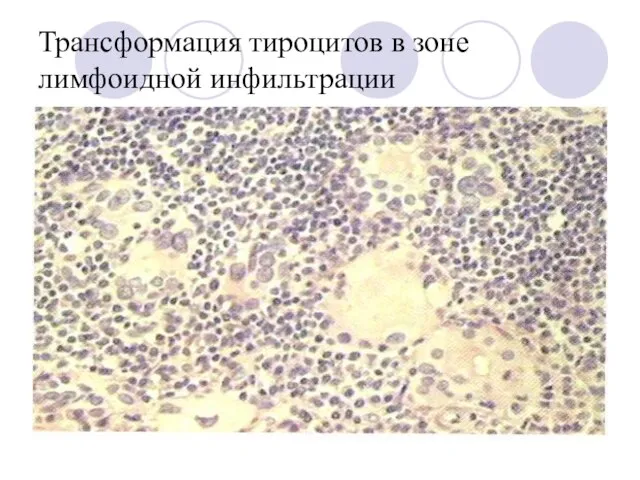 Трансформация тироцитов в зоне лимфоидной инфильтрации