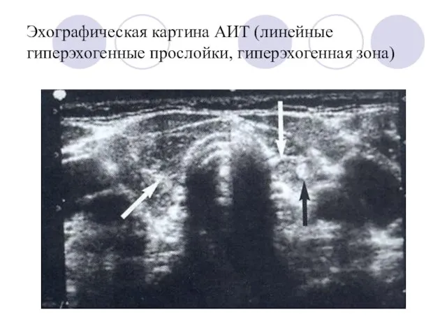 Эхографическая картина АИТ (линейные гиперэхогенные прослойки, гиперэхогенная зона)
