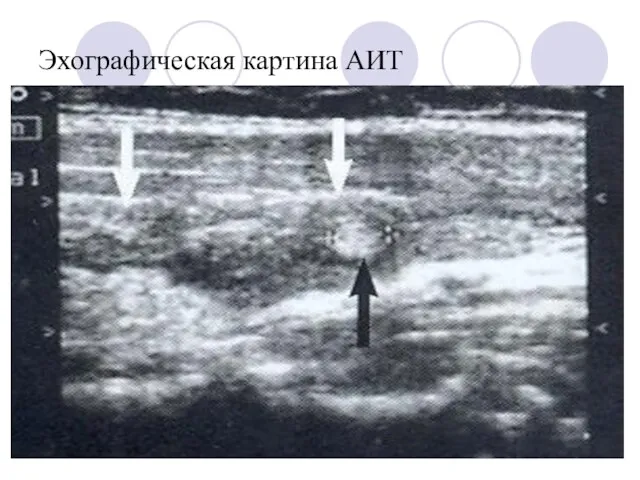 Эхографическая картина АИТ