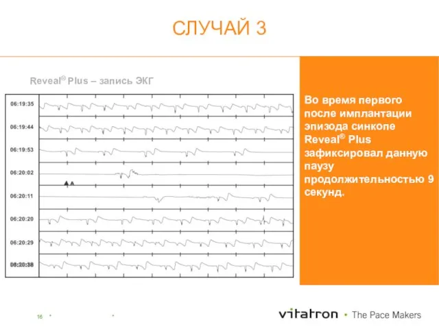 Reveal® Plus – запись ЭКГ Во время первого после имплантации эпизода синкопе