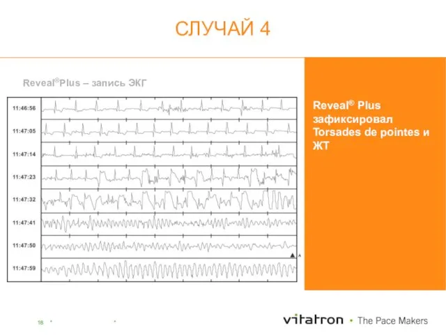 Reveal® Plus зафиксировал Torsades de pointes и ЖТ Reveal®Plus – запись ЭКГ СЛУЧАЙ 4