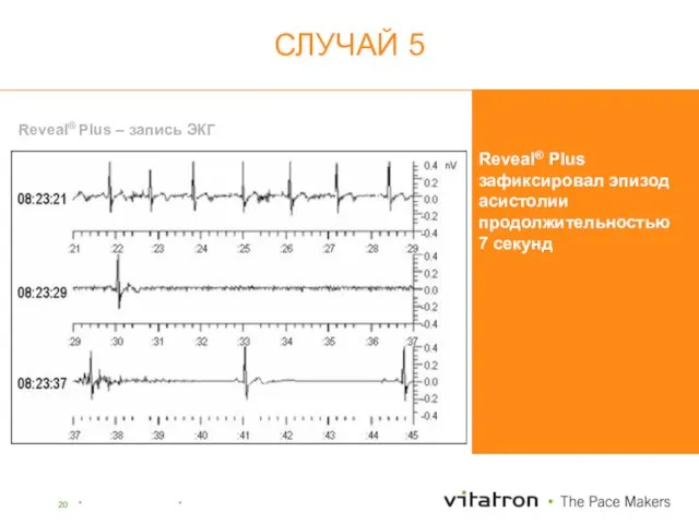 Reveal® Plus зафиксировал эпизод асистолии продолжительностью 7 секунд Reveal® Plus – запись ЭКГ СЛУЧАЙ 5